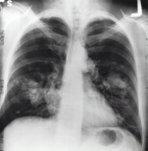 肺癌 肺部 肺臟 胸腔